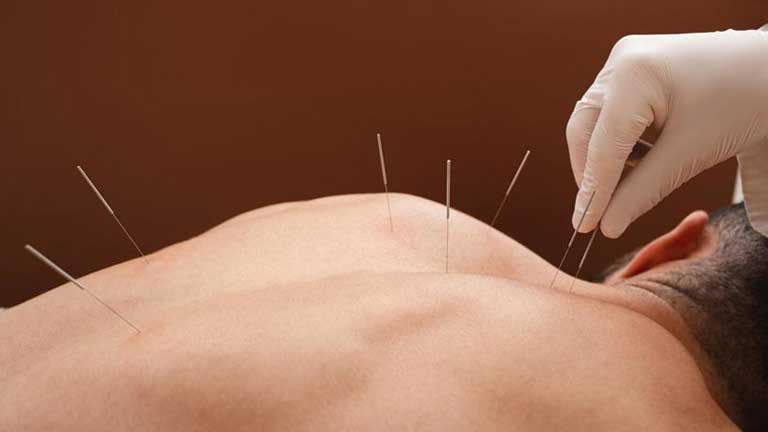 Acupuncture