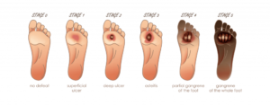 foot-ulcer classification