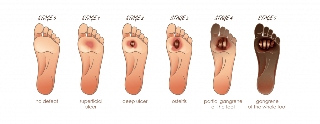 foot-ulcer classification